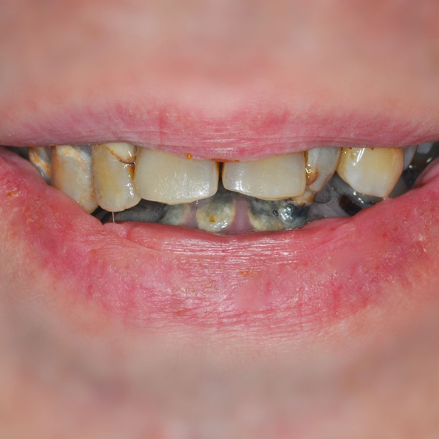 Teeth in a Day Procedure - After - 3Dental